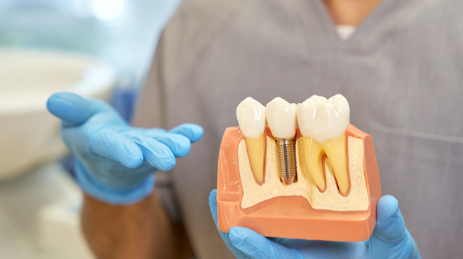 Cosa sono gli impianti dentali?
