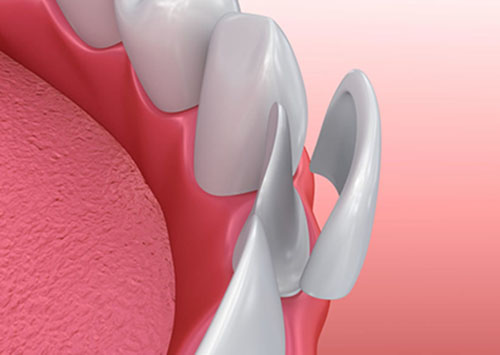 ricostruzione grafica di faccette dentali estetiche